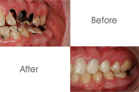 Before and After Bonding and Restoration Dental Procedure In Gainesville