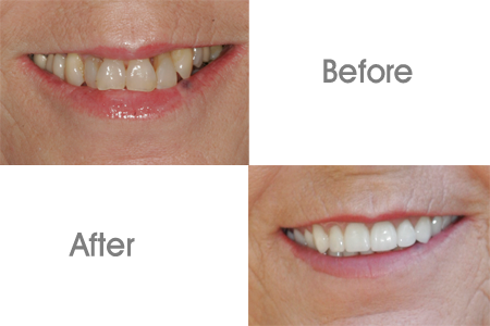 Before and After Dental Crowns Procedure At Smiles By Dixon