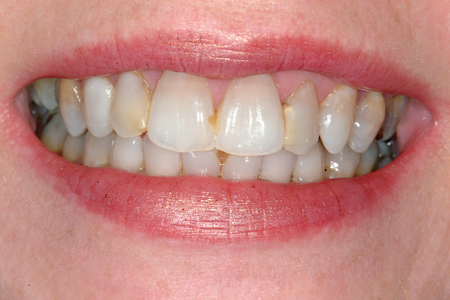 Before Full Mouth Restoration Procedure Photos At Smiles By Dixon